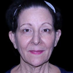 Facelift Before & After Patient #9909