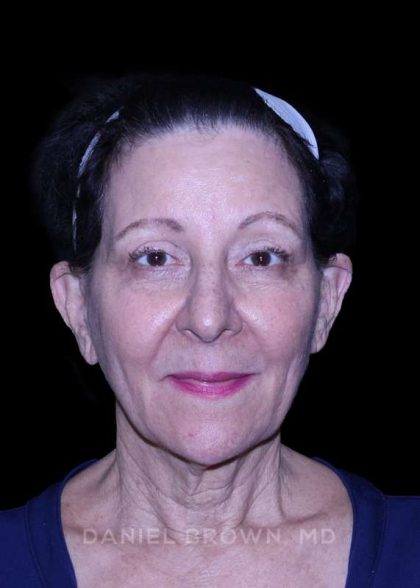 Facelift Before & After Patient #9909