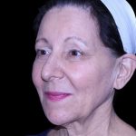 Facelift Before & After Patient #9909