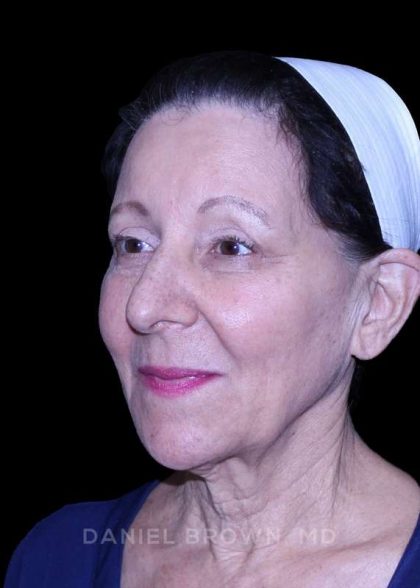 Facelift Before & After Patient #9909