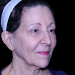 Facelift Before & After Patient #9909