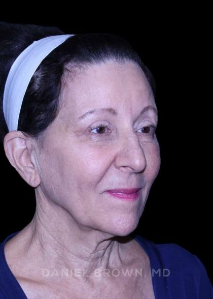 Facelift Before & After Patient #9909