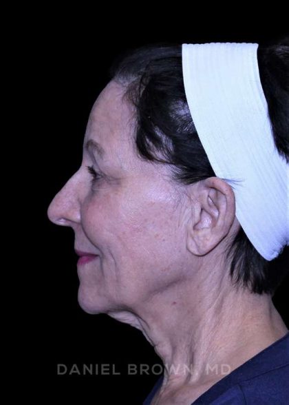 Facelift Before & After Patient #9909
