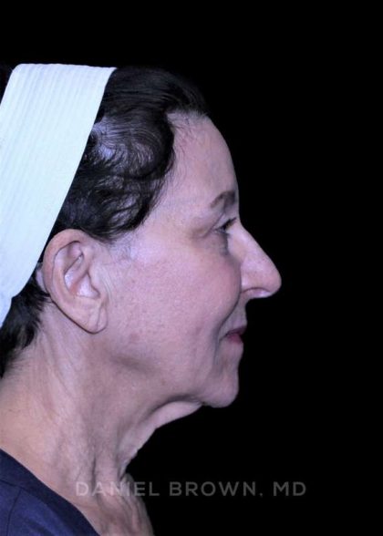 Facelift Before & After Patient #9909