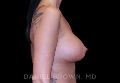 Breast Lift & Implant Before & After Patient #9610