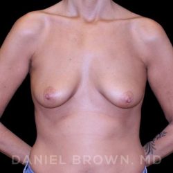 Breast Lift & Implant Before & After Patient #9610