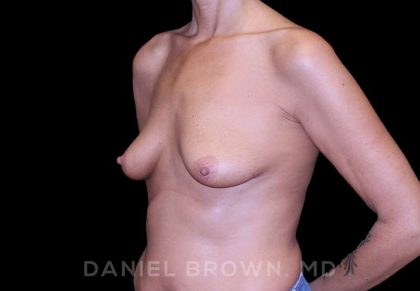 Breast Lift & Implant Before & After Patient #9610