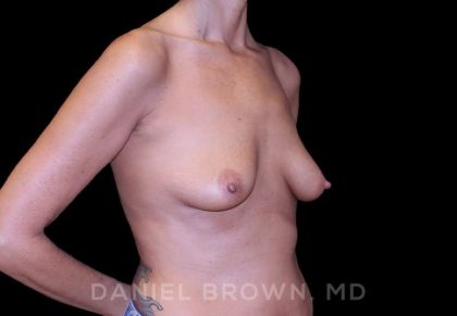 Breast Lift & Implant Before & After Patient #9610