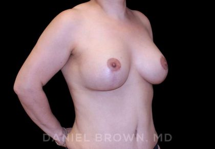 Breast Lift & Implant Before & After Patient #9621