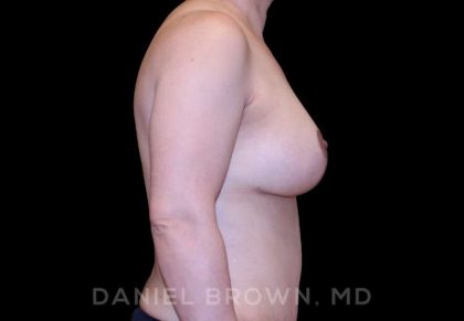 Breast Lift & Implant Before & After Patient #9621
