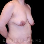 Breast Lift & Implant Before & After Patient #9621
