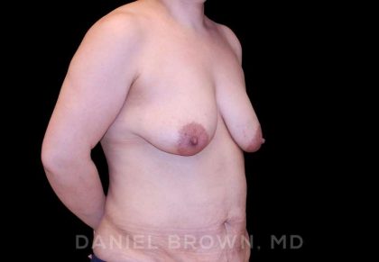 Breast Lift & Implant Before & After Patient #9621
