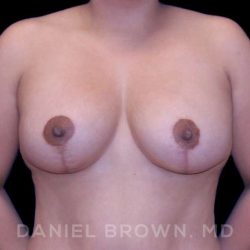 Breast Lift & Implant Before & After Patient #9632