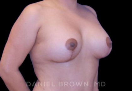 Breast Lift & Implant Before & After Patient #9632