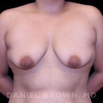 Breast Lift & Implant Before & After Patient #9632