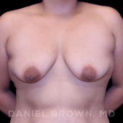 Breast Lift & Implant Before & After Patient #9632