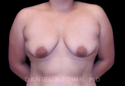 Breast Lift & Implant Before & After Patient #9632