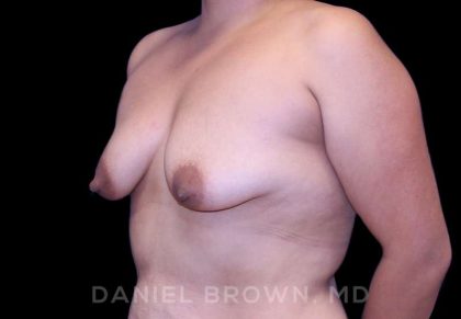 Breast Lift & Implant Before & After Patient #9632