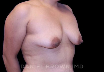 Breast Lift & Implant Before & After Patient #9632