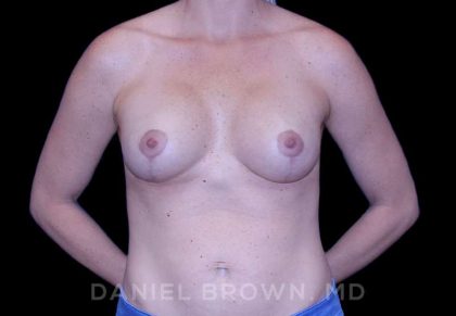 Breast Lift & Implant Before & After Patient #9643