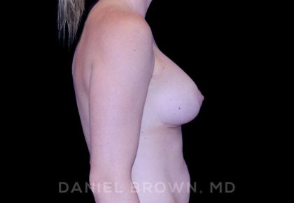Breast Lift & Implant Before & After Patient #9643