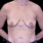 Breast Lift & Implant Before & After Patient #9643