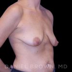 Breast Lift & Implant Before & After Patient #9643