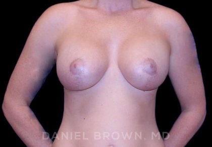 Breast Lift & Implant Before & After Patient #9654