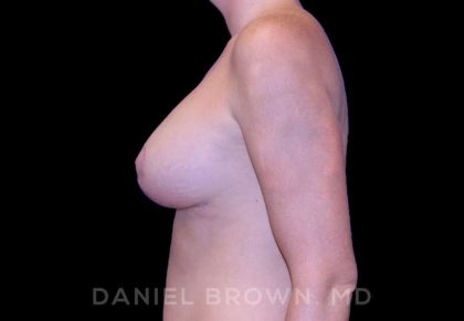 Breast Lift & Implant Before & After Patient #9654