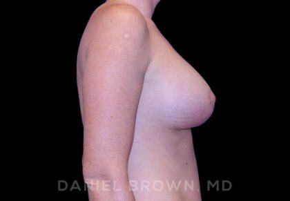 Breast Lift & Implant Before & After Patient #9654