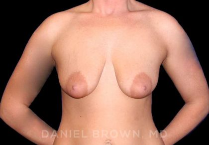 Breast Lift & Implant Before & After Patient #9654
