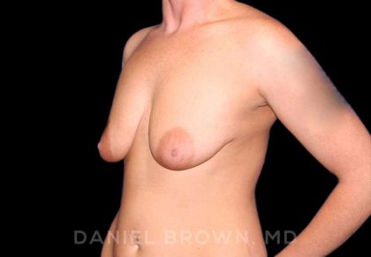 Breast Lift & Implant Before & After Patient #9654