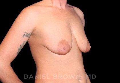Breast Lift & Implant Before & After Patient #9654