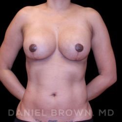 Breast Lift & Implant Before & After Patient #9665