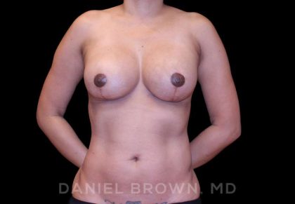 Breast Lift & Implant Before & After Patient #9665