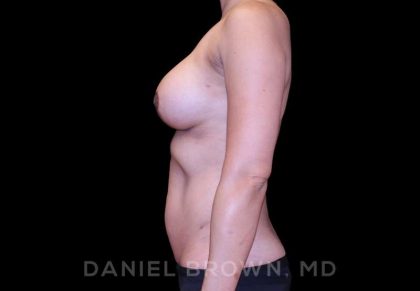 Breast Lift & Implant Before & After Patient #9665