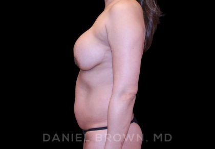 Breast Lift & Implant Before & After Patient #9665