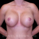 Breast Lift & Implant Before & After Patient #9676