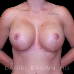 Breast Lift & Implant Before & After Patient #9676