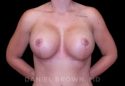 Breast Lift & Implant Before & After Patient #9676
