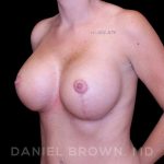 Breast Lift & Implant Before & After Patient #9676