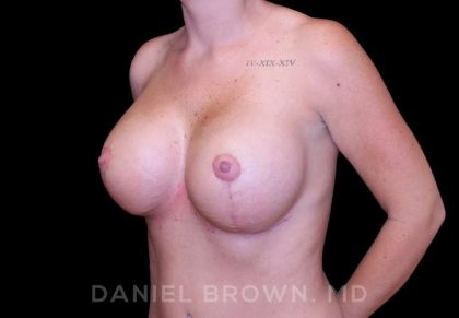 Breast Lift & Implant Before & After Patient #9676