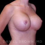 Breast Lift & Implant Before & After Patient #9676