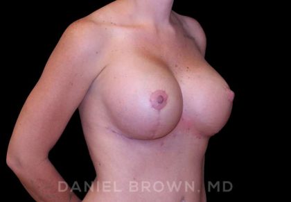 Breast Lift & Implant Before & After Patient #9676
