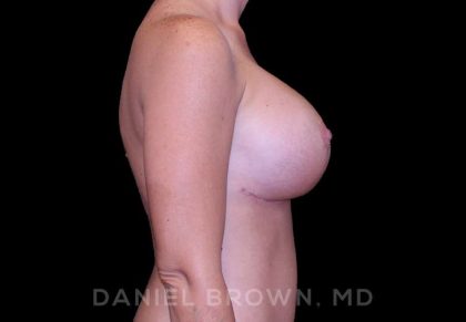 Breast Lift & Implant Before & After Patient #9676