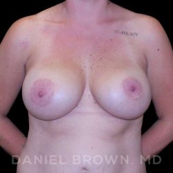 Breast Lift & Implant Before & After Patient #9676