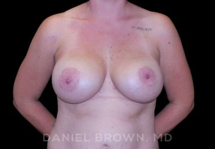 Breast Lift & Implant Before & After Patient #9676