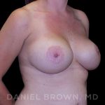 Breast Lift & Implant Before & After Patient #9676