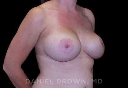 Breast Lift & Implant Before & After Patient #9676