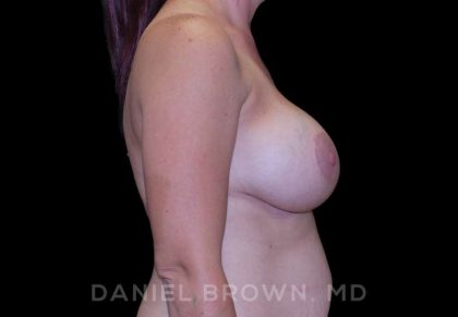 Breast Lift & Implant Before & After Patient #9676